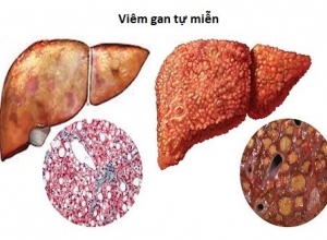 Bệnh Viêm Gan Tự Miễn Là Gì ? Những Điều Cần Biết Về Bệnh Viêm  Gan Tự Miễn